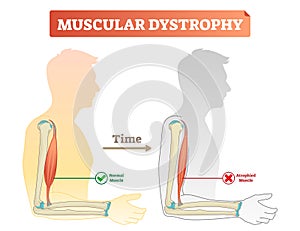 Vector illustration about muscular dystrophy. Compared normal muscle and atrophied muscle. Scheme with healthy and weak human. photo