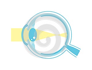 Vector illustration of myopia (no text
