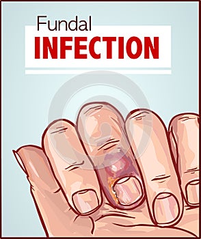 Vector illustration of a Nail Fungal Infection