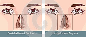Vector illustration of a Nasal Septum Deviation Treatmen
