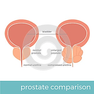 Vector illustration of normal and enlarged prostate