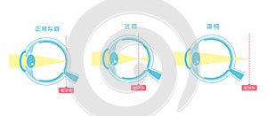 Vector illustration of normal vision and myopia and hyperopia