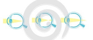 Vector illustration of normal vision and myopia and hyperopia