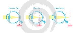 Vector illustration of normal vision and myopia and hyperopia