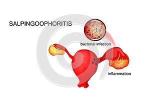 Vector illustration of oophoritis photo