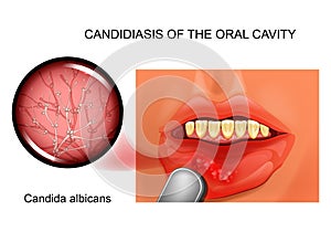 Candidiasis of the oral cavity photo