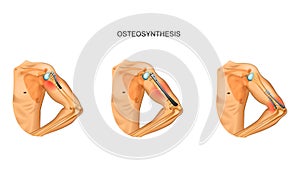 Osteosynthesis of the humerus
