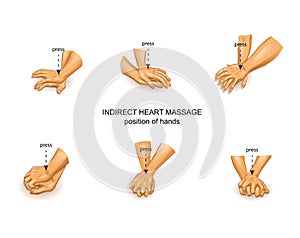Position of the doctor`s hands in indirect heart massage photo