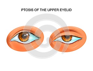 Ptosis of the eyelid photo