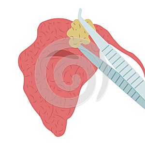 Vector illustration of removing a stone from the parotid salivary gland photo
