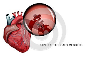 Rupture of blood vessels of the heart photo