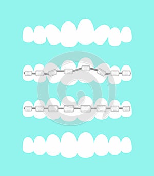 Vector illustration set of teeth, dental orthodontics treatment with teeth braces, process of level teeth, beautiful