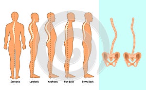 Vector illustration of spinal deformity types: scoliosis, lordosis and kyphosis. Body posture defect. Infographics of spine diseas