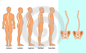 Vector illustration of spinal deformity types: scoliosis, lordosis and kyphosis. Body posture defect. Infographics of spine diseas photo