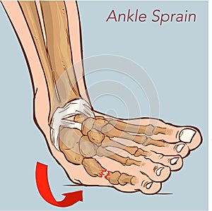 Vector illustration of a Sprained ankle