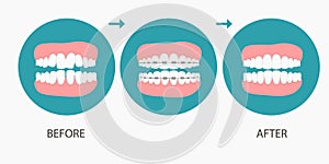 Vector illustration of stages of orthodontic treatment braces on teeth . Teeth before , after braces on . Background in flat style