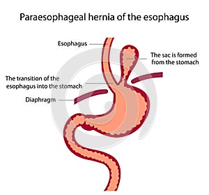 Vector illustration of stomach disease.