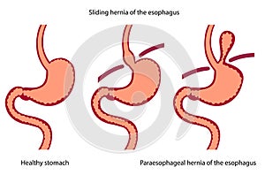 Vector illustration of stomach disease.