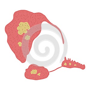Vector illustration of stones in the salivary glands.