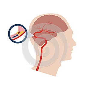 Vector illustration of a stroke