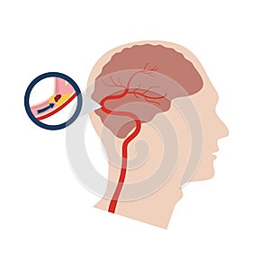 Vector illustration of a stroke photo