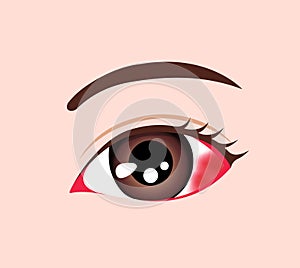 Vector illustration of subconjunctival hemorrhage
