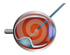 Vector illustration of the subretinal injection