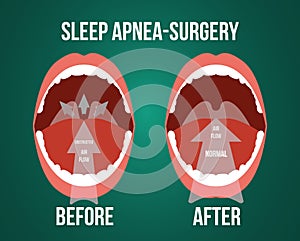 Vector illustration of surgery for obstructive sleep apnea.