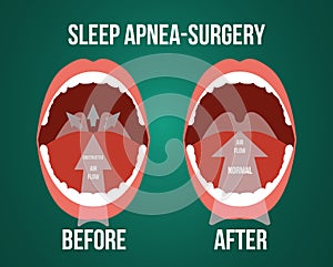 Vector illustration of surgery for obstructive sleep apnea. photo