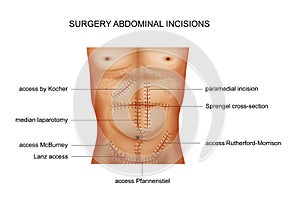 Surgical incisions of the abdominal cavity photo