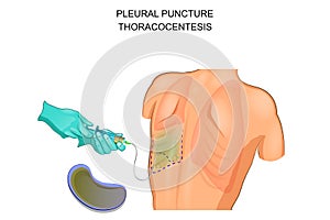 Thoracocentesis, pleural puncture photo