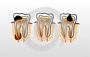 Vector illustration of tooth Decay Caries