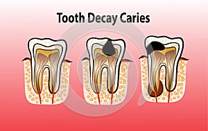 Vector illustration of tooth Decay Caries