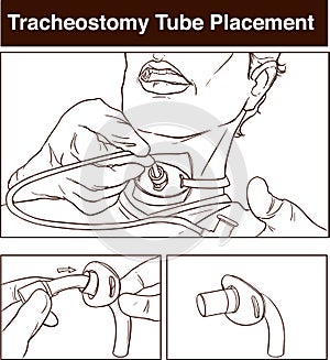 vector illustration of a tracheostomy tube placement