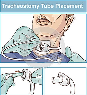 vector illustration of a tracheostomy tube placement