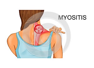 Trapezius muscle. the incidence of myositis photo