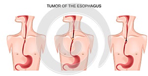 Tumor of the esophagus photo