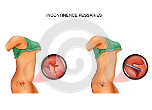 Use of pessary for incontinence photo