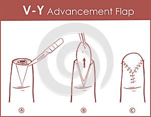 Vector illustration of a V-Y advancement flap