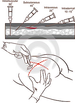 Vector illustration of a veins of the arm