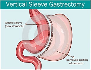 Vector illustration of Vertical Sleeve Gastrectomy