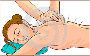 A vector illustration of a woman receiving acupuncture treatment