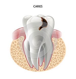 Vector image tooth caries disease