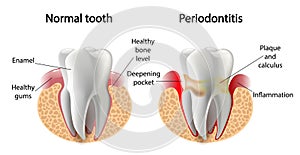 Vector image tooth Periodontitis disease photo