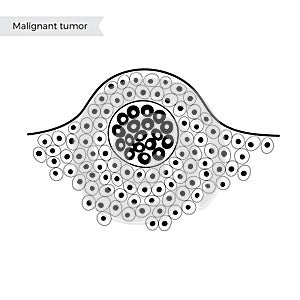 Vector isolated illustration of benign tumor