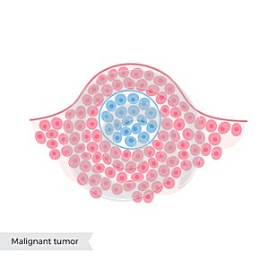 Vector isolated illustration of benign tumor