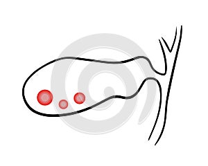 Vector isolated illustration of gall bladder.Gallstones