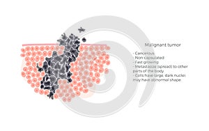 Vector isolated illustration of malignant tumor