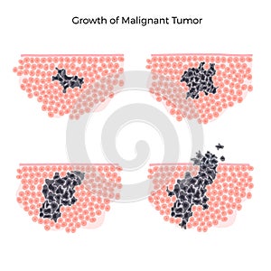 Vector isolated illustration of malignant tumor