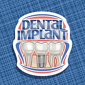 Vector logo for Dental Implant